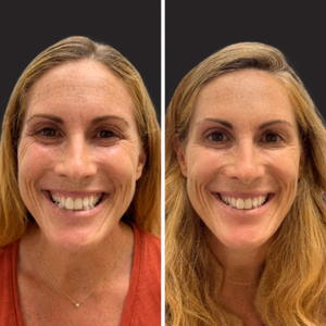 Botox before and after photo, close-up view