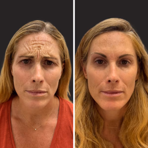 Botox before and after photo, close-up view