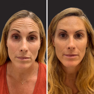 Botox before and after photo, close-up view
