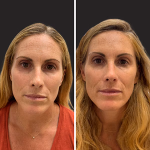 Botox before and after photo, close-up view