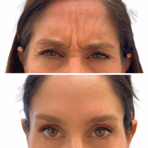 Botox before and after photo, close-up view