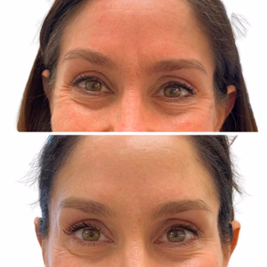 Botox before and after photo, close-up view