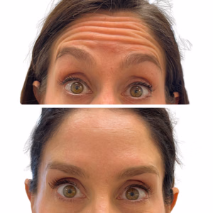 Botox before and after photo, close-up view