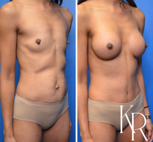 Nipple reduction before and after photo, close-up view