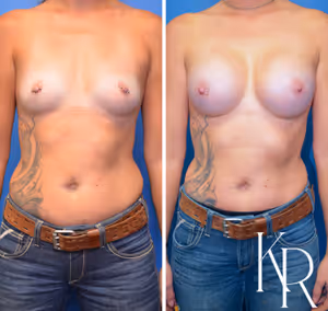 Breast augmentation before and after photo, front view