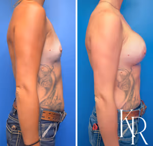 Breast augmentation before and after photo, side view