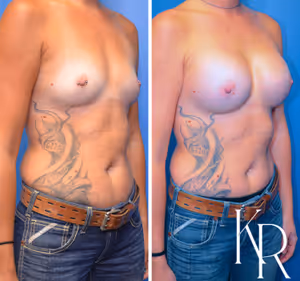 Breast augmentation before and after photo, front view
