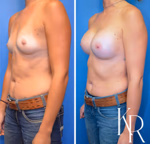 Breast augmentation before and after photo, side view