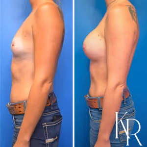 Breast augmentation before and after photo, side view