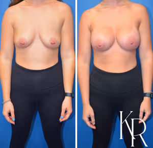 Breast augmentation before and after photo, front view