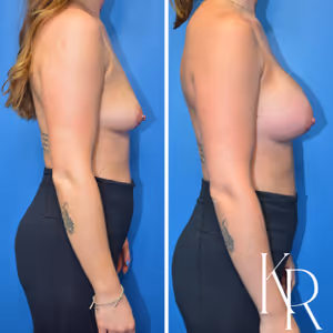Breast augmentation before and after photo, side view
