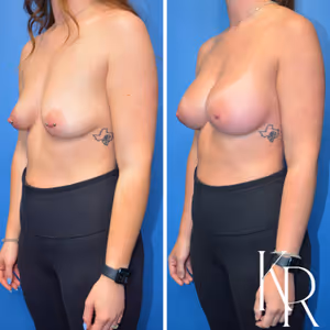 Breast augmentation before and after photo, front view