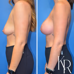 Breast augmentation before and after photo, side view