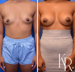 Breast augmentation before and after photo, front view