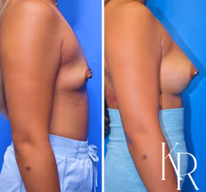 Breast augmentation before and after photo, side view