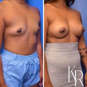 Breast augmentation before and after photo, front view