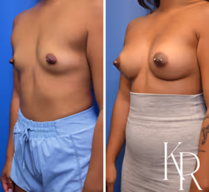 Breast augmentation before and after photo, front view