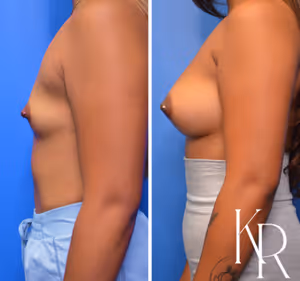 Breast augmentation before and after photo, side view