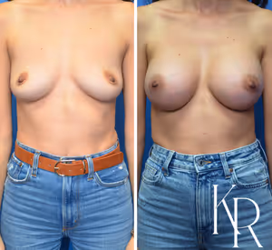 Breast augmentation before and after photo, front view