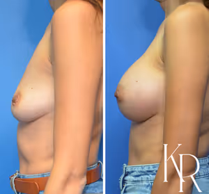 Breast augmentation before and after photo, side view