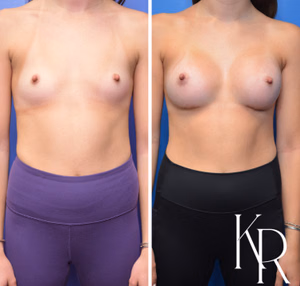 Breast augmentation before and after photo, front view