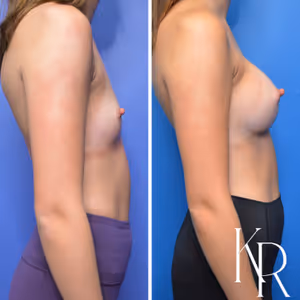 Breast augmentation before and after photo, side view
