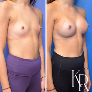 Breast augmentation before and after photo, front view