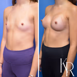 Breast augmentation before and after photo, front view