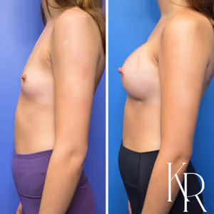 Breast augmentation before and after photo, side view