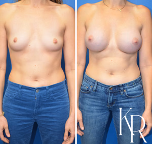 Breast augmentation before and after photo, front view