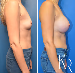 Breast augmentation before and after photo, side view