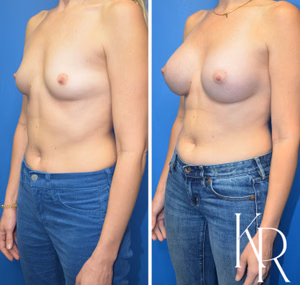Breast augmentation before and after photo, front view