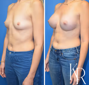 Breast augmentation before and after photo, front view