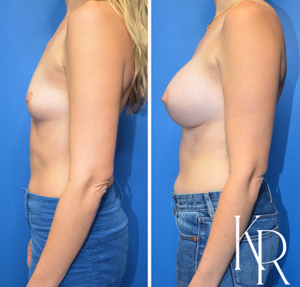 Breast augmentation before and after photo, side view