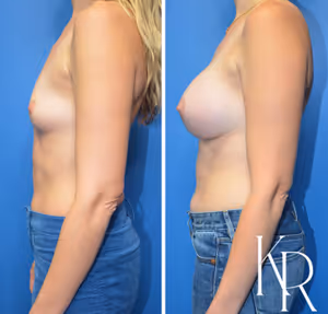 Breast augmentation before and after photo, side view