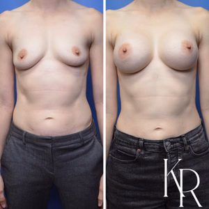 Breast augmentation before and after photo, side view
