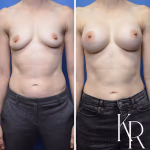 Breast augmentation before and after photo, side view