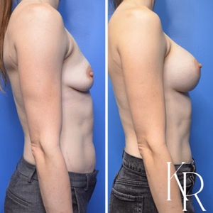 Breast augmentation before and after photo, front view