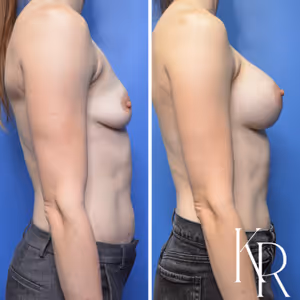 Breast augmentation before and after photo, front view