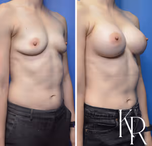 Breast augmentation before and after photo, front view