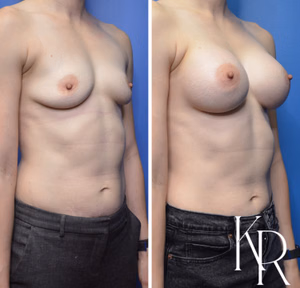 Breast augmentation before and after photo, front view
