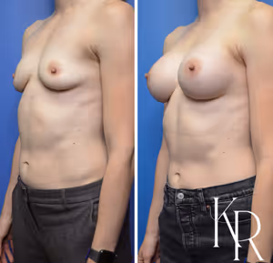 Breast augmentation before and after photo, front view