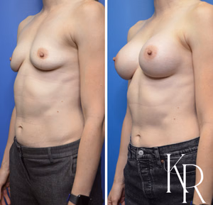 Breast augmentation before and after photo, front view