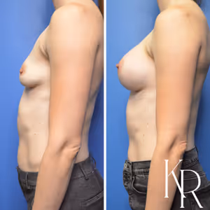 Breast augmentation before and after photo, side view