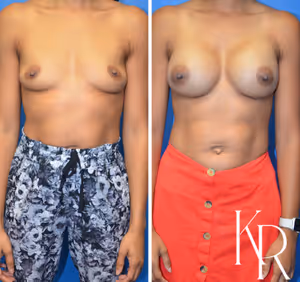 Breast augmentation before and after photo, front view