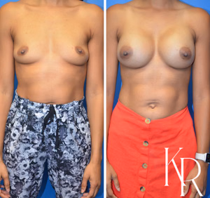 Breast augmentation before and after photo, front view
