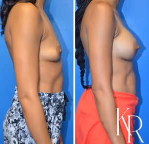 Breast augmentation before and after photo, side view