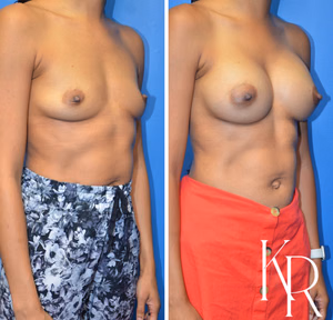 Breast augmentation before and after photo, front view