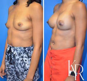 Breast augmentation before and after photo, front view