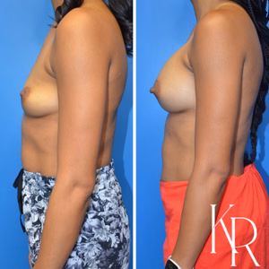 Breast augmentation before and after photo, side view